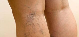 Varices sur les jambes. 